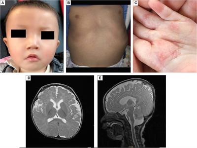 A Novel de novo Mutation in EBF3 Associated With Hypotonia, Ataxia, and Delayed Development Syndrome in a Chinese Boy